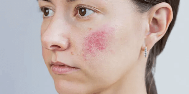 안면홍조 vs 주사피부염&amp;#44; 닮았지만 완전히 다른 빨간 얼굴 고민~!