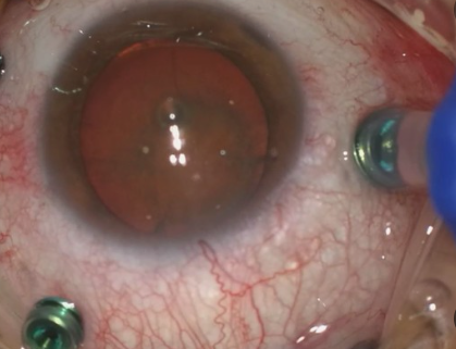 백내장의 증상과 수술 받은 후기와 비용 그리고 관리법과 주의사항