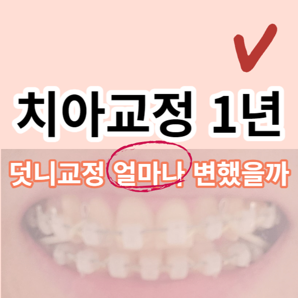 치아교정 1년후 얼마나 달라졌을까