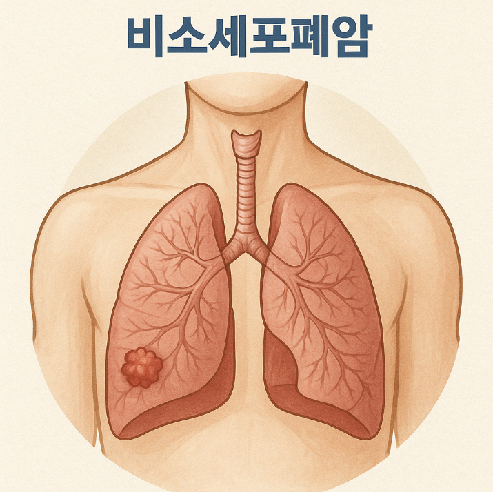폐암에서의 면역항암치료: 비소세포폐암에 혁명을 일으킨 요법