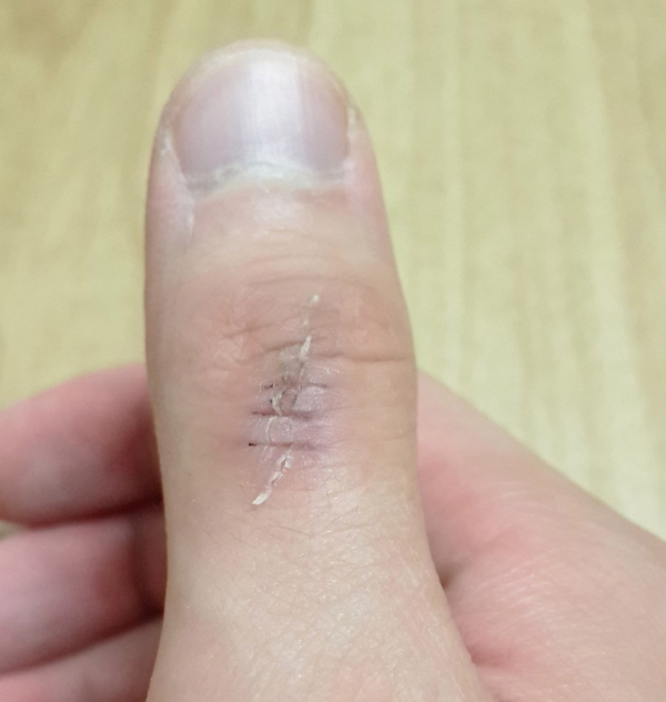 엄지손가락-찢어짐-실밥제거후