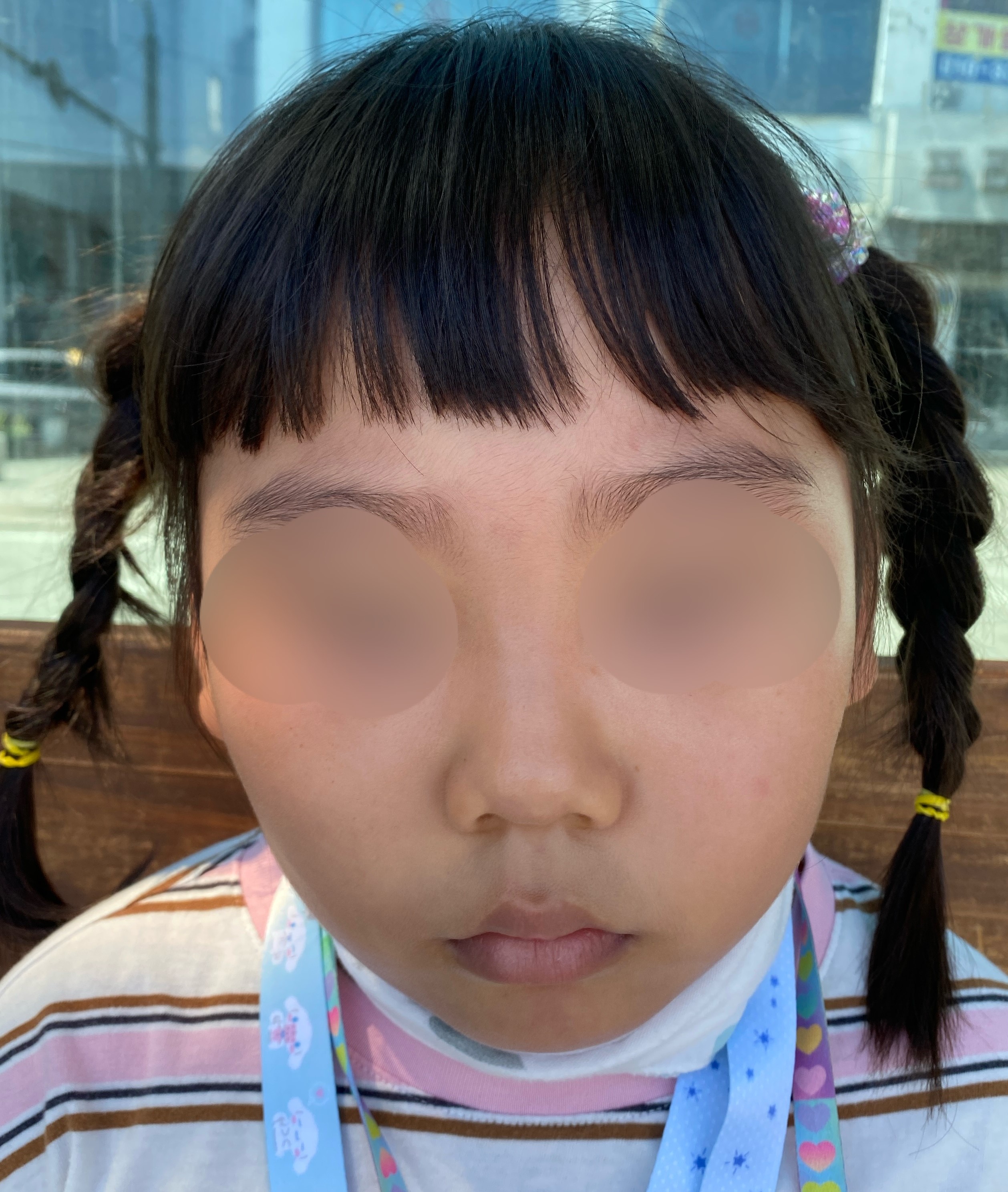 1년 후 흉터 없이 깨끗해진 피부