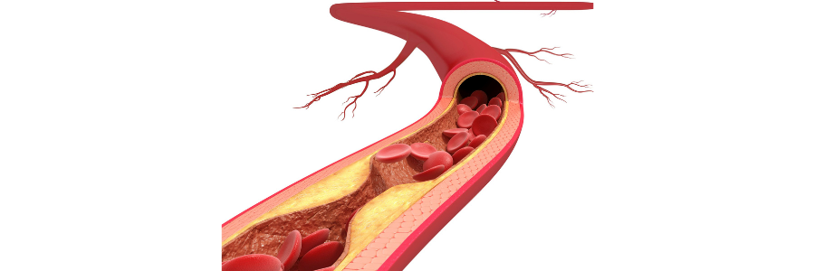 혈관-이미지-고지혈