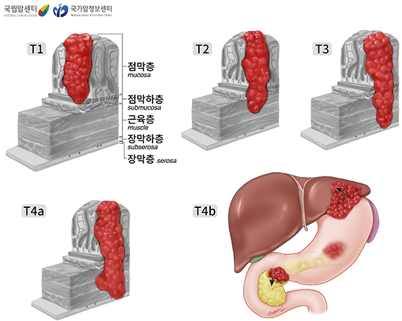 위암