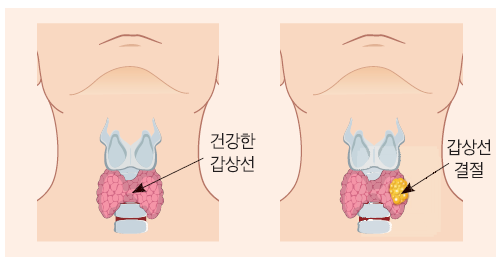 ebs 명의 갑상선 치료 예방