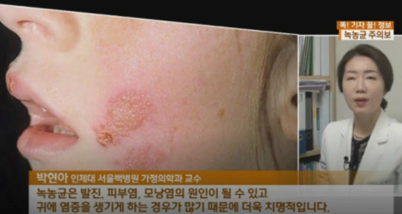 녹농균이 피부에 미치는 영향 인터뷰