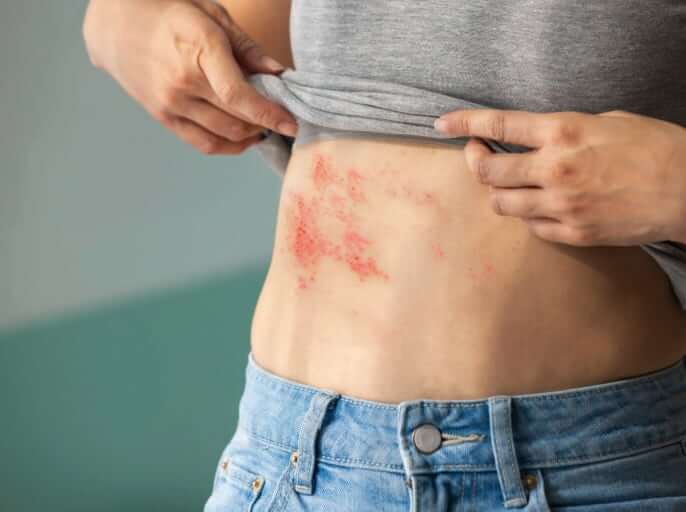 대상포진에 좋은 음식