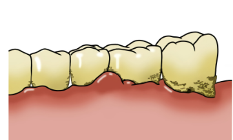 잇몸이 자주 붓는 이유