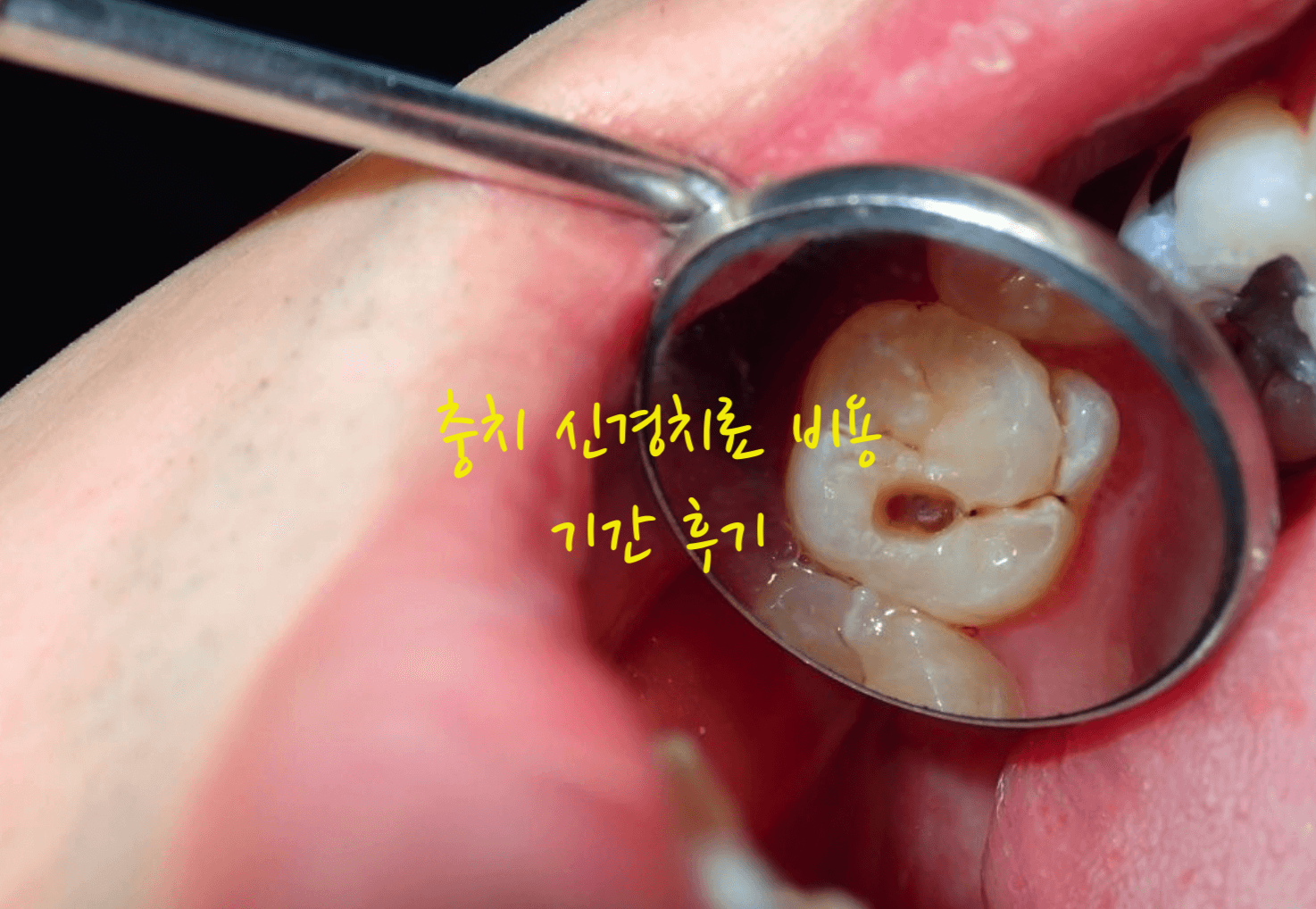 충치 신경치료