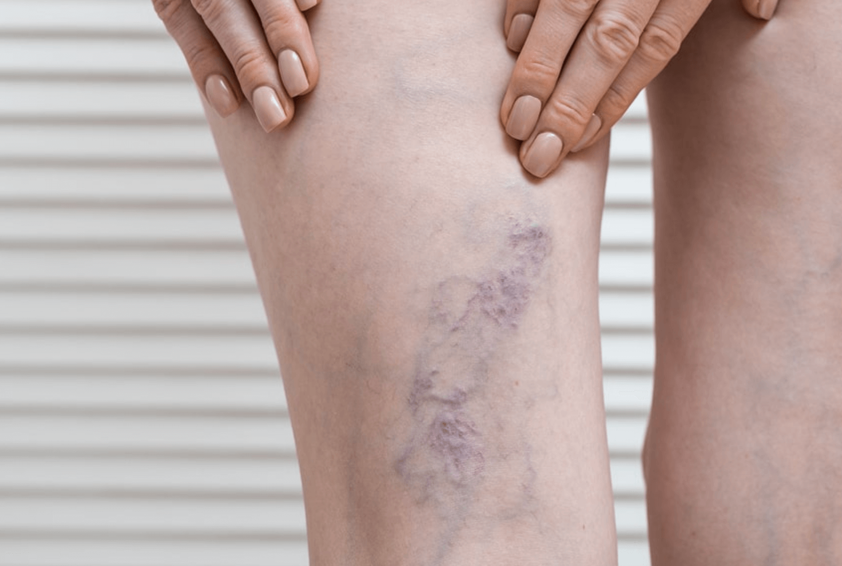 하지정맥류 수술