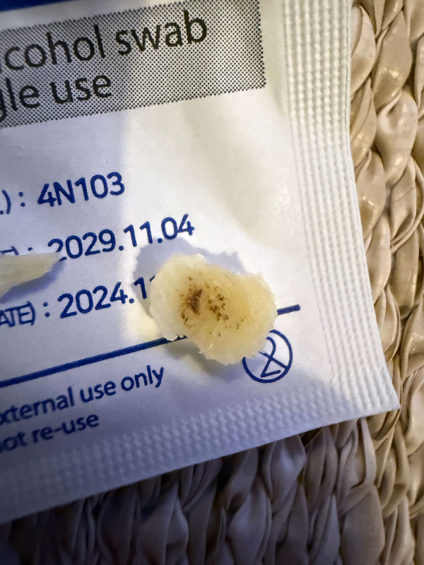 족저사마귀-자기치료-사진