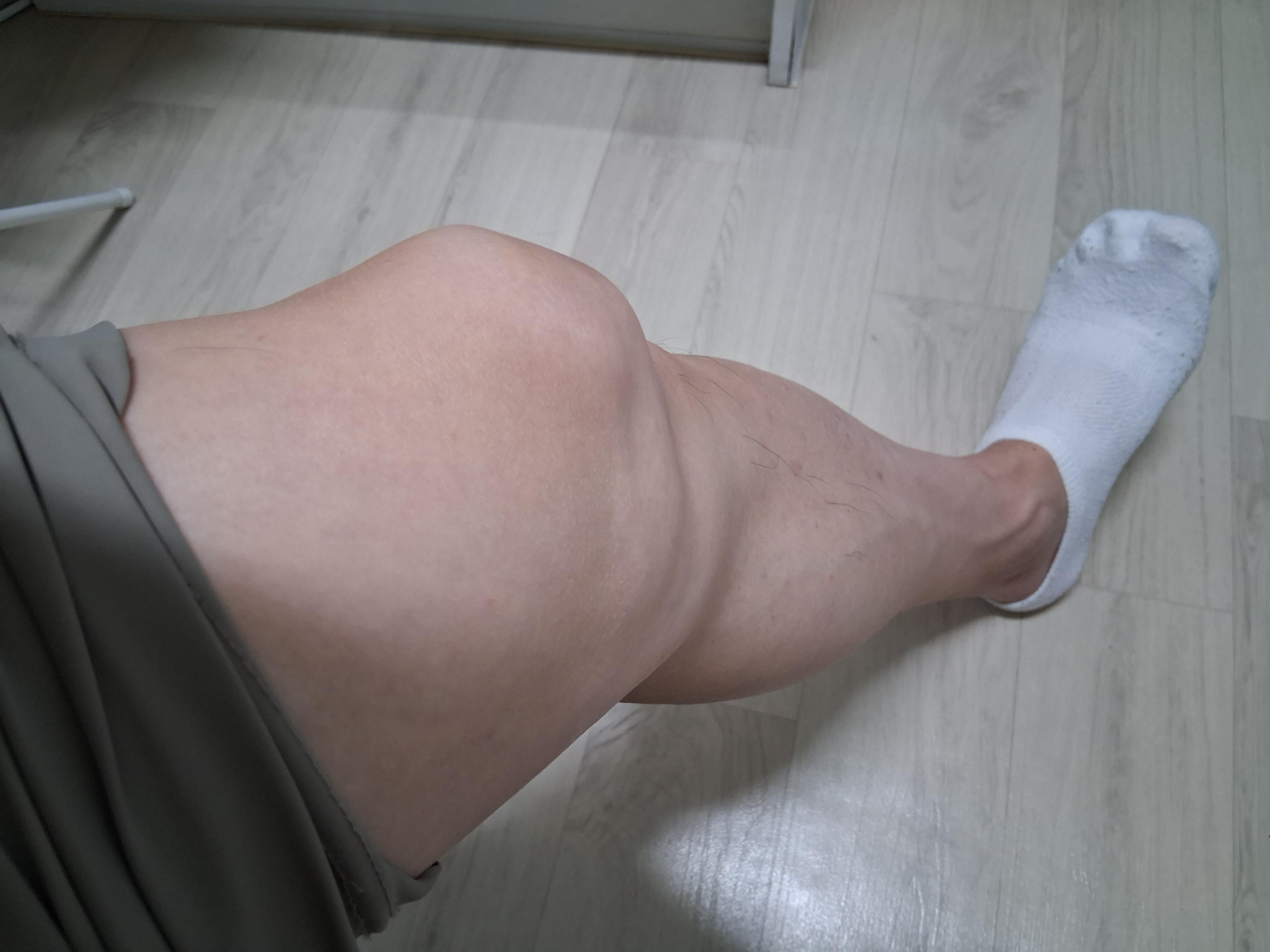 계단에서 통증을 경험한 무릎
