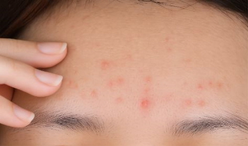 이마 좁쌀여드름 관련 사진