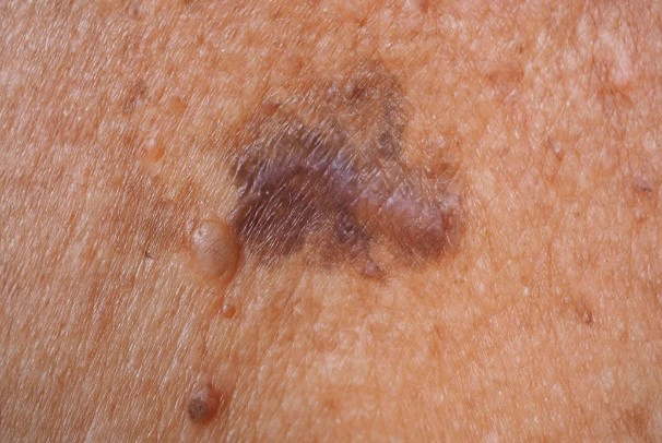 흑색종 점모양 피부암 수술사례