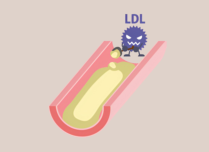 LDL-콜레스테롤