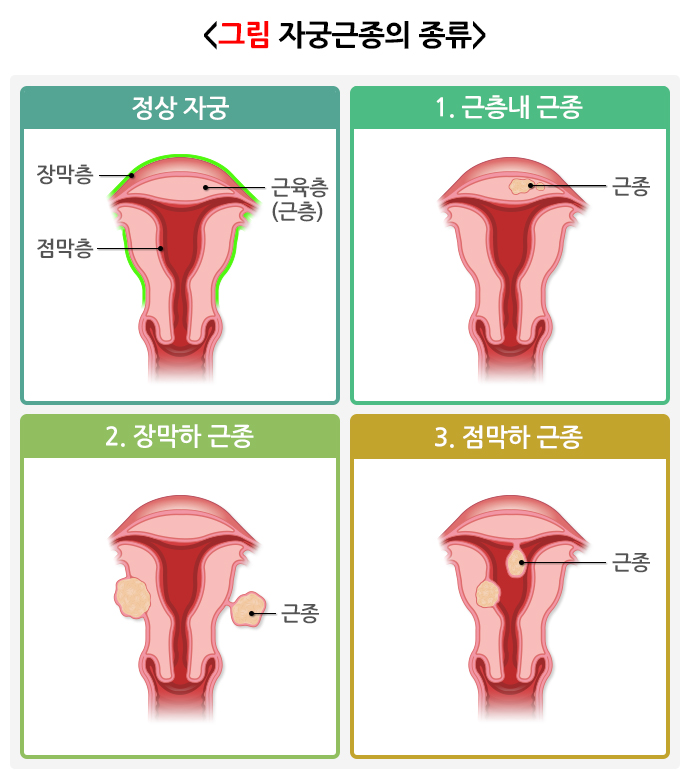 정상자궁과 자궁근종
