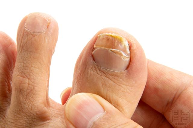 발이 보내는 위험한 신호 발톱 두껍고 변색 발톱무좀