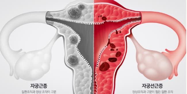 자궁선근증수술
