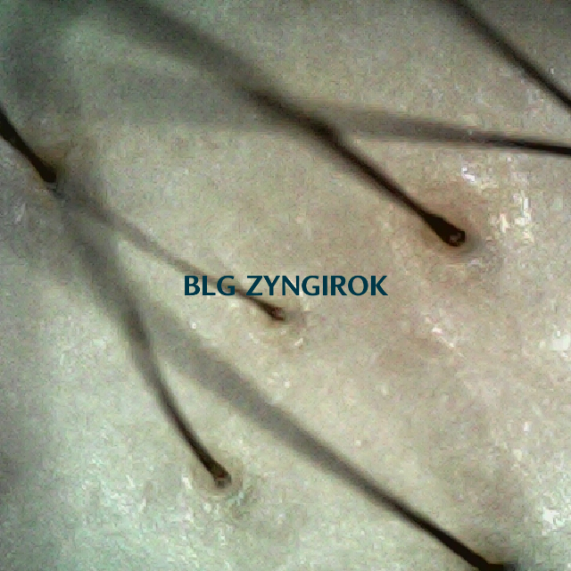 피나모아 복용 17주차 - 정수리와 이마 사이 부분이다.