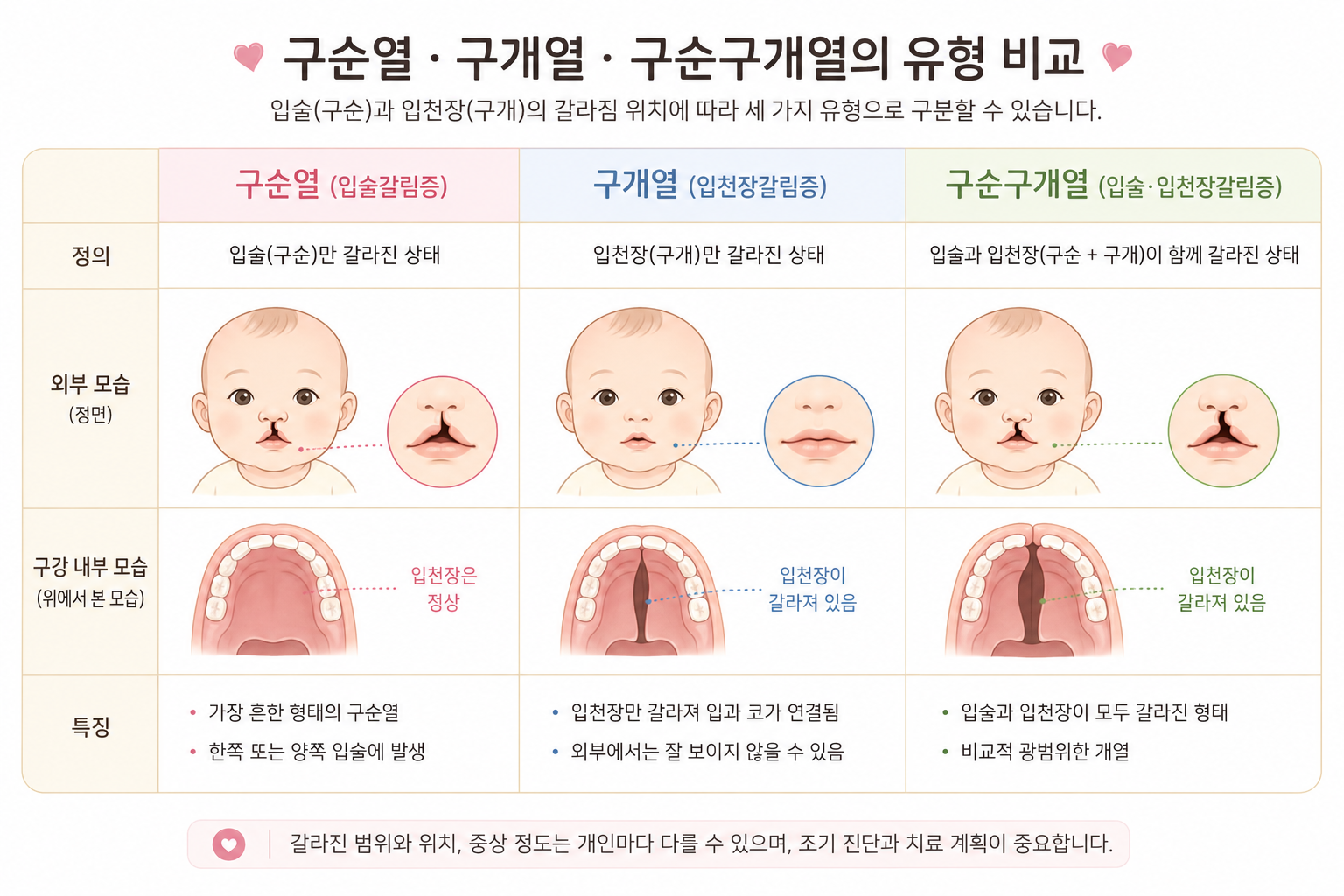 구순열, 구개열, 구순구개열 비교 인포그래픽