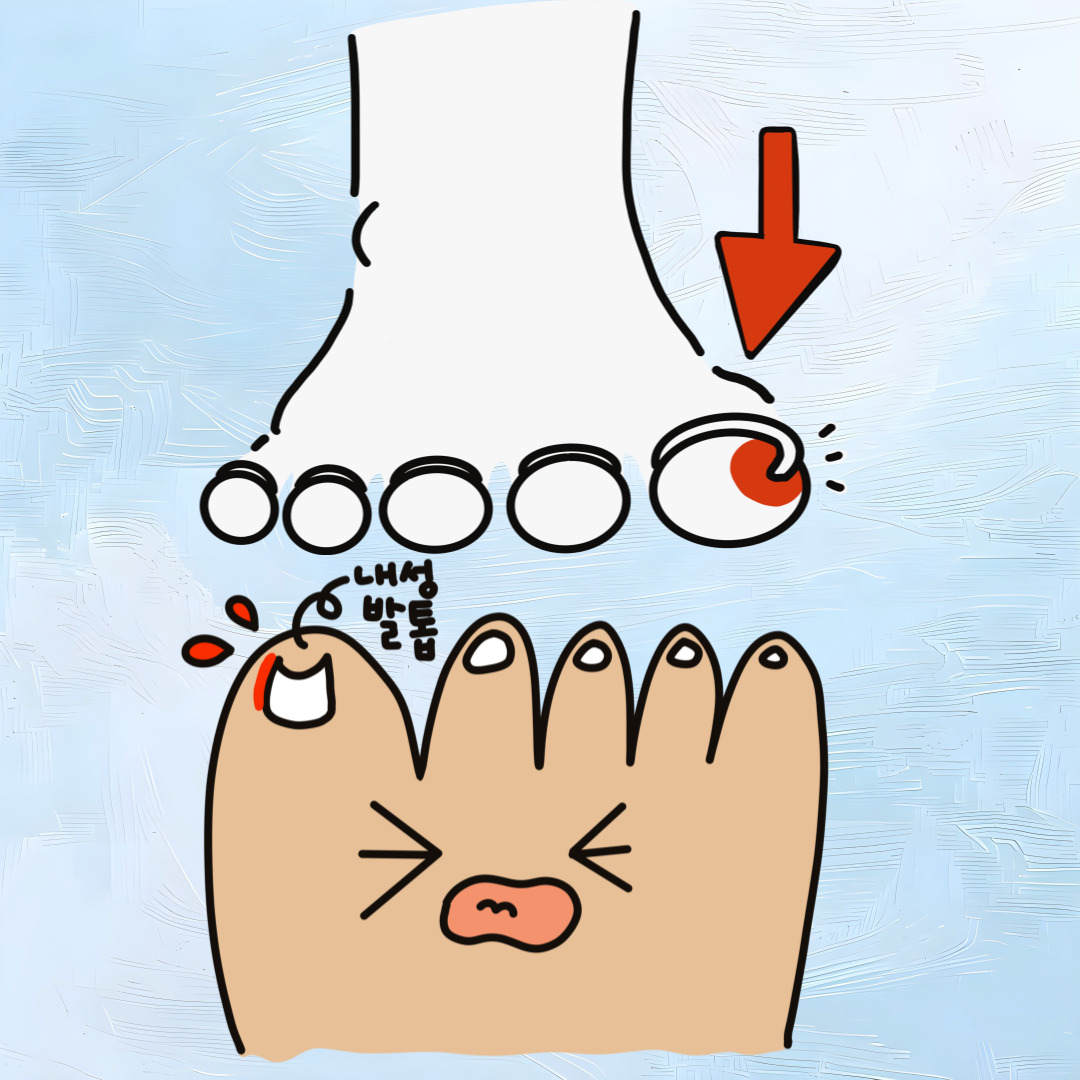 내성발톱 관련 그림