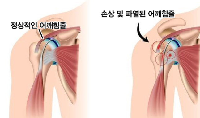 어깨 힘줄 파열의 원인과 증상,