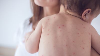 홍역(Measles): 증상, 치료법, 예방 방법 및 최근 유행 원인