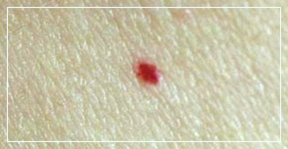 몸에-빨간점이-생기는-이유