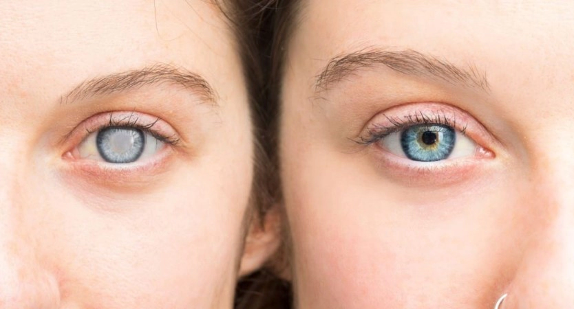 노안 백내장 수술 비용