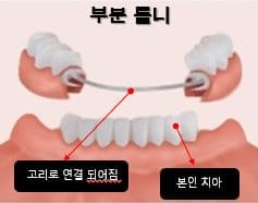 부분-틀니-종류