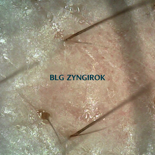 피나모아 복용 28주차 오른쪽 M자 부위 두피모습이다.