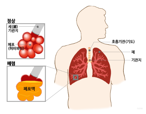 폐렴_원인_증상_치료_예방방법_좋은음식