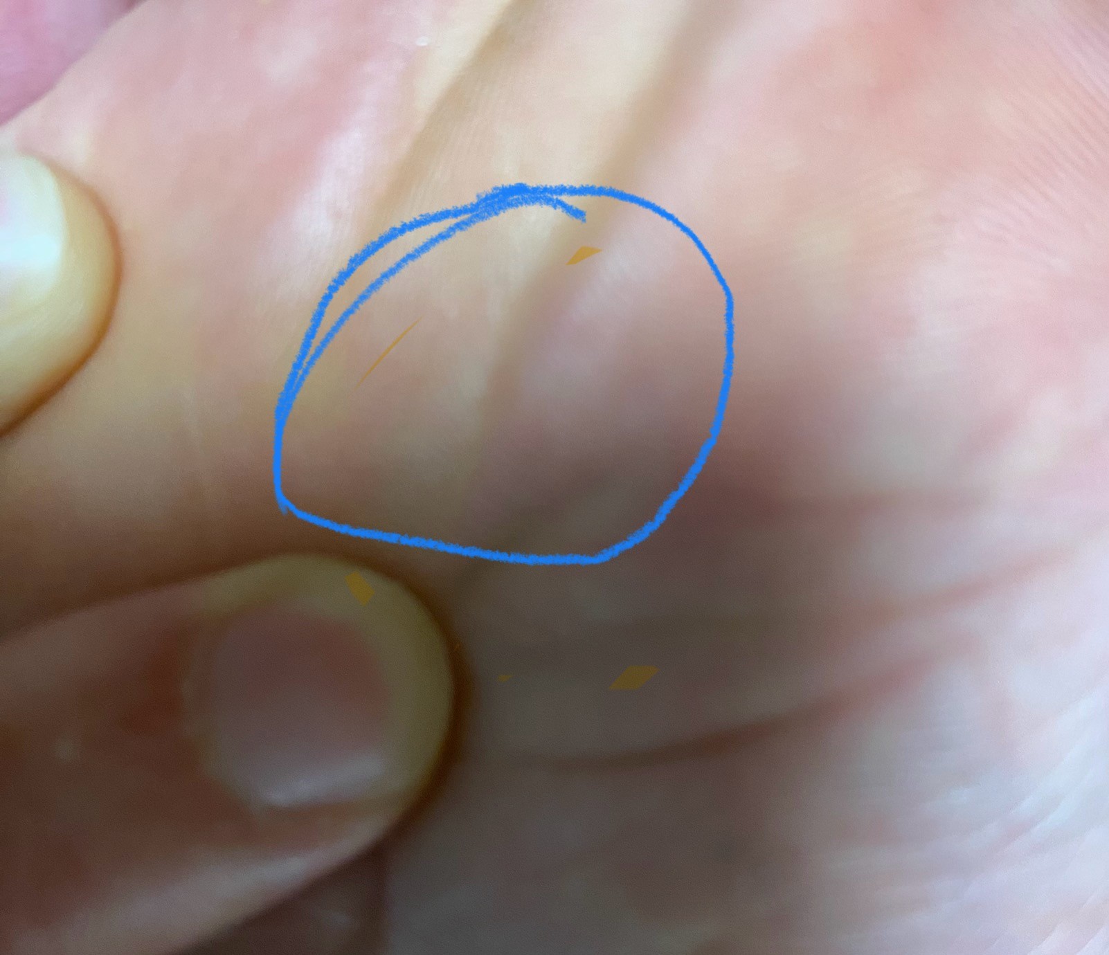 두둥 한달정도 지난 후 모습 자연스러운 발바닥을 볼 수 있었어요.