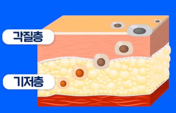 탄 피부 회복법