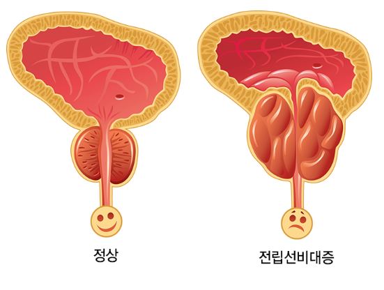 전립선-비대증-치료약-쏘팔메토-성분