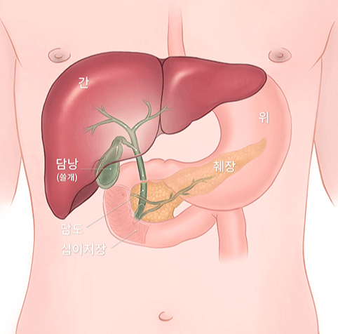 담낭선근종증 분절형