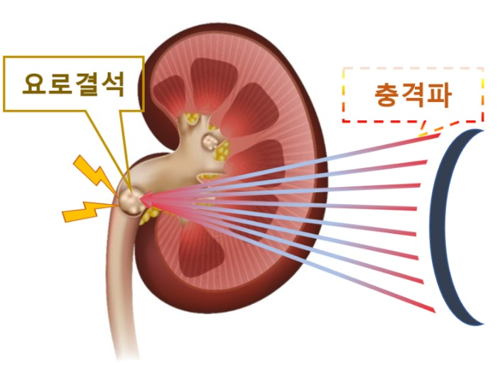 체외충격파쇄석술 비용