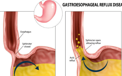 역류성 식도염 증상 10가지, 자연치료 방법