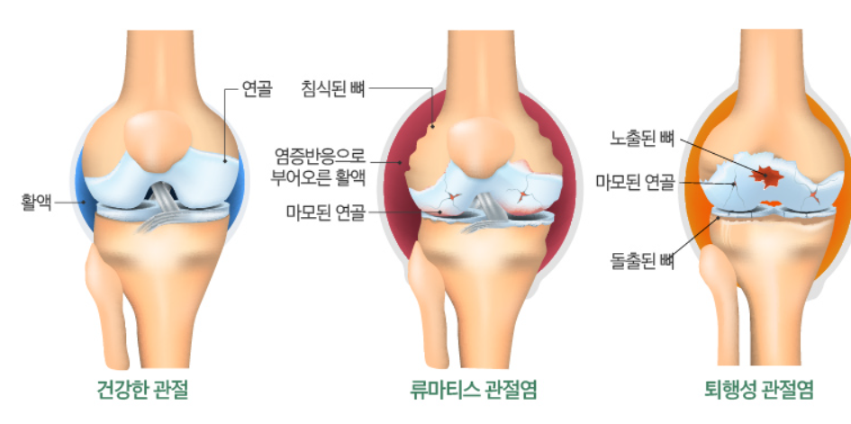 퇴행성 관절염과 류마티스 관절염 차이