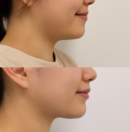 이중턱이-사라진-여성의-전-후-사진입니다.