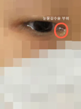 눈물샘 뚫는 수술 간단한가요에 대한 수술정보_14