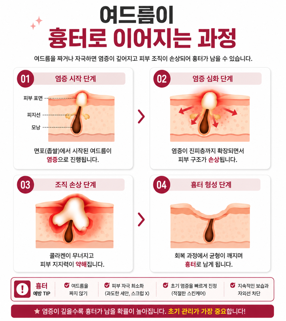 여드름이 흉터로 이어지는 과정