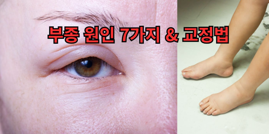 전신 부종 원인을 직관적으로 표현한 일러스트로, 얼굴과 다리의 붓기가 강조된 이미지