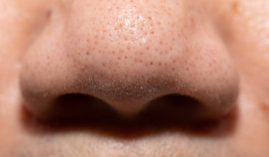 피지 과다 분비