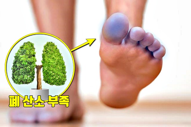 폐렴 증상,손 발 입술 파랗게 청색증