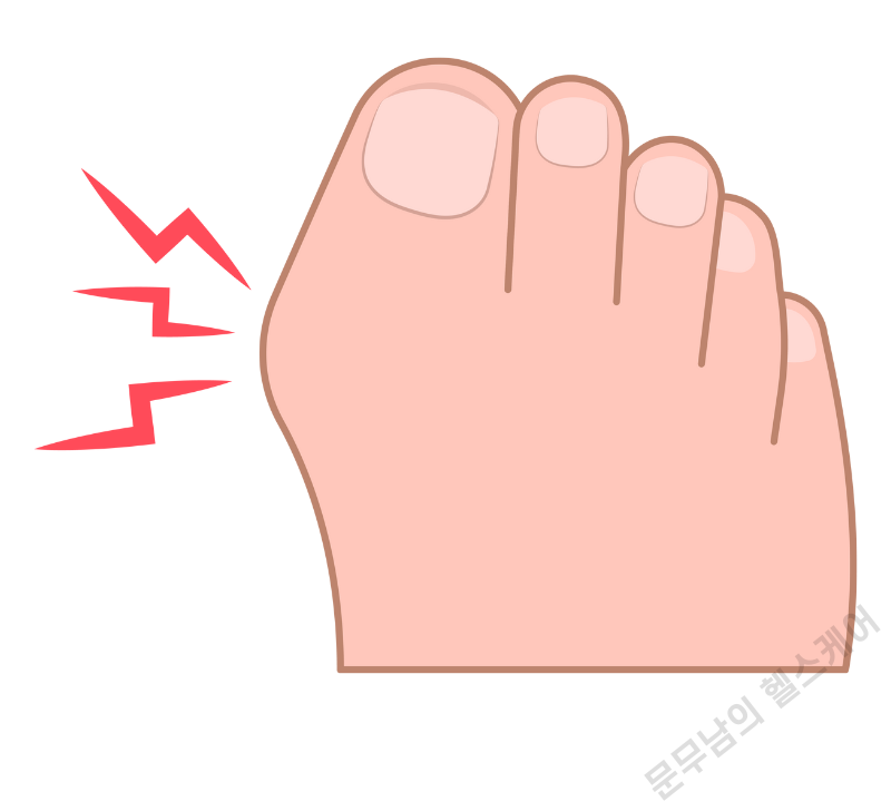 엄지발가락 옆 통증