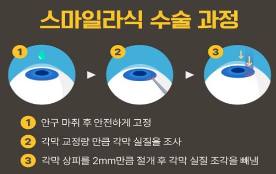 스마일라식-과정