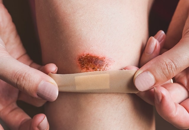 일본 전염병 STSS