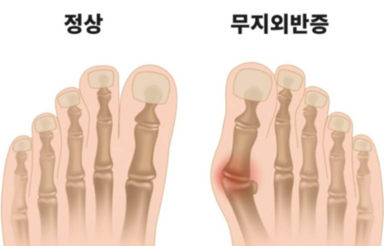 무지외반증 일반인과의 차이