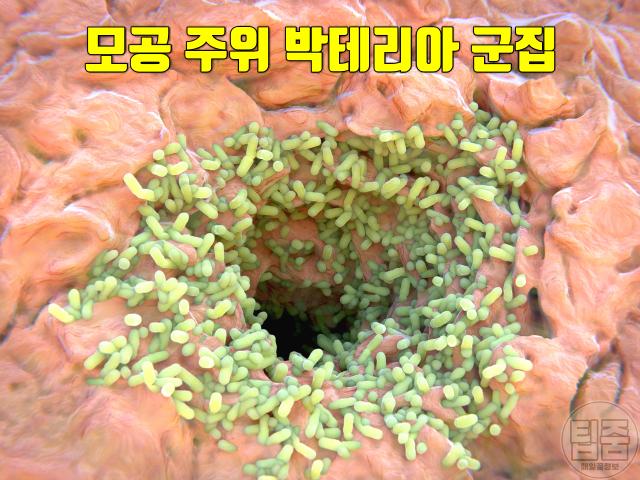 노인냄새 원인 제거 노네날 피부박테리아